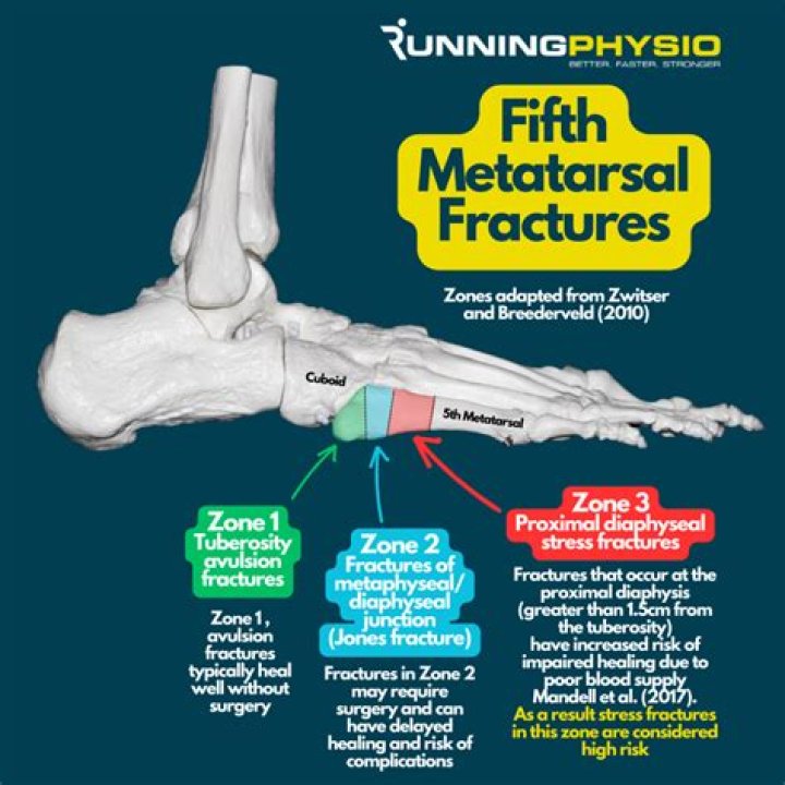 Why is fracture disabled valorant